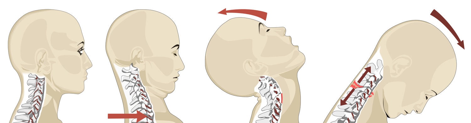 Diagram of whiplash neck injury